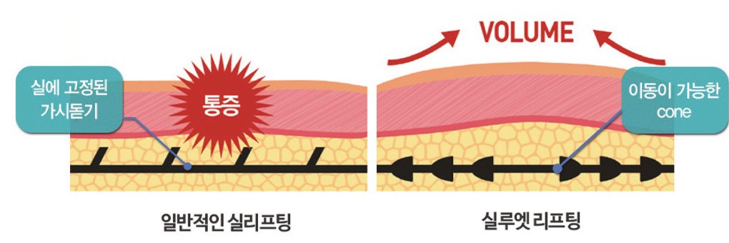 실에 고정된 가시돌기 실리프팅과 이동 가능한 콘의 실루엣 리프팅 비교 그림